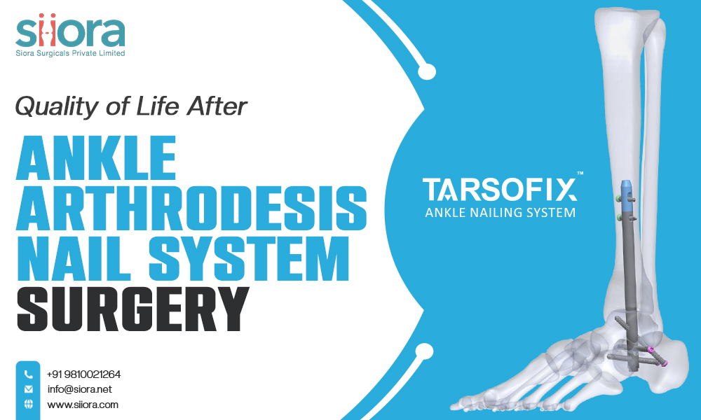 Quality of Life After Ankle Arthrodesis Nail System&nbsp;Surgery